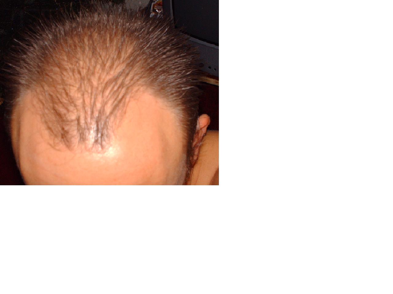 http://www.alopezie.de/diskussion/transplant/uploads/Tonspur.JPG