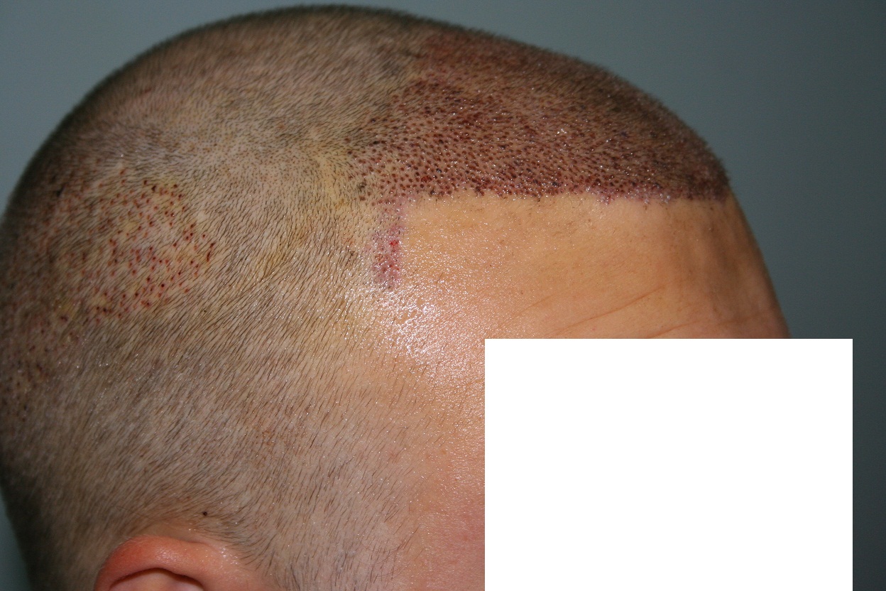 http://www.alopezie.de/foren/transplant/index.php/fa/12604/