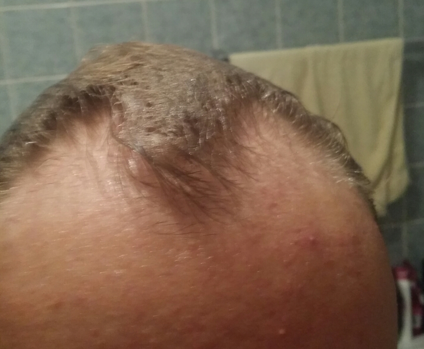 Ist Es Androgenetische Alopezie Oder Doch Wegen Der Akne Der Haarausfall Onmeda Forum
