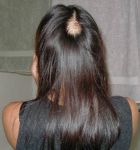 Alopecia Areata