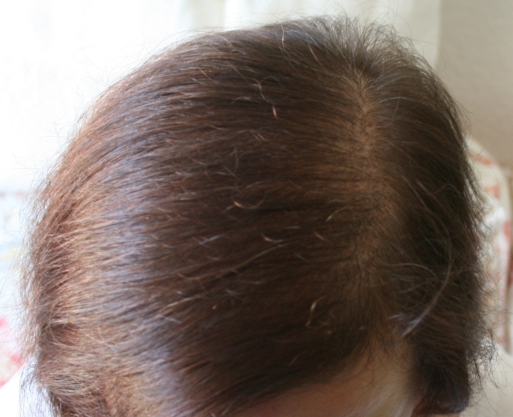 Haare oberkopf wenig am Ausgedünnte Haare
