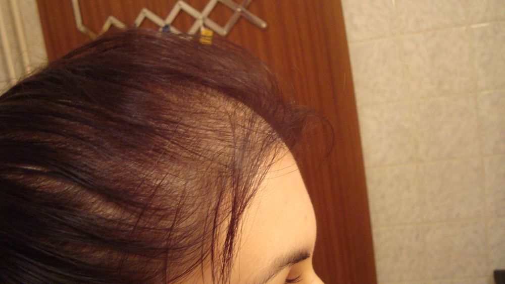 Stirn haarausfall frau vorne Haarausfall Haaransatz