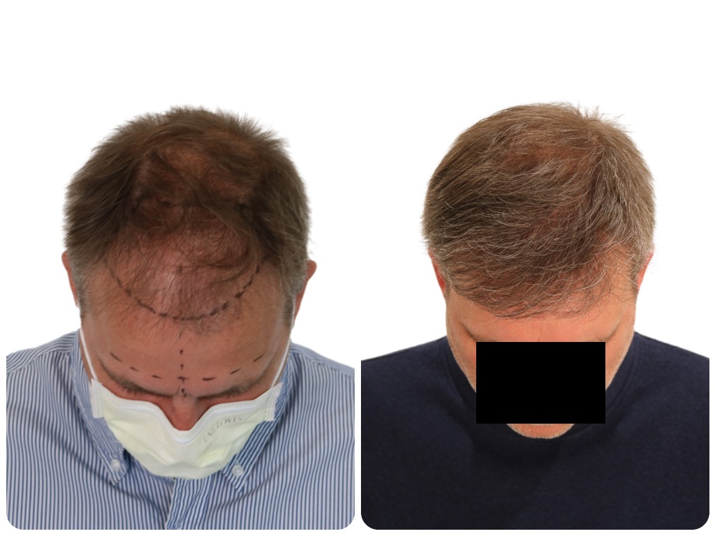 /foren/transplant/index.php/fa/52122/0/