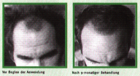 Sidhu anlagebd. Haarausfall